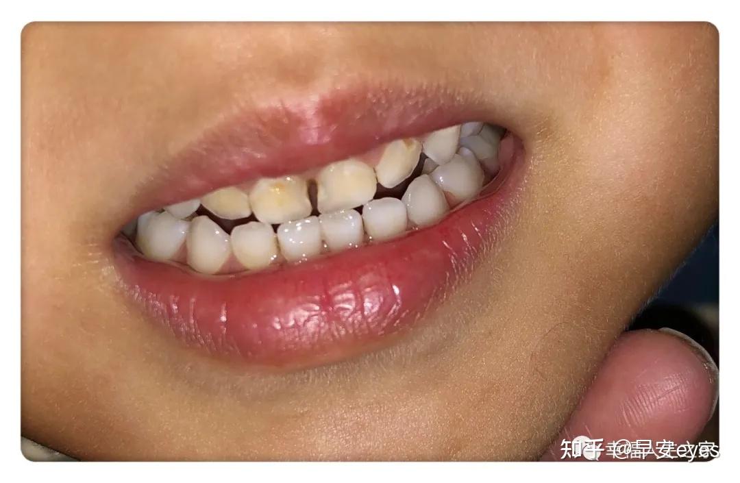 【分享】4岁孩子补了8颗牙(一)妈妈自我察觉篇 