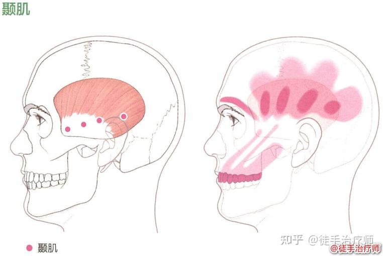 颞肌激痛点及牵涉痛 - 知乎