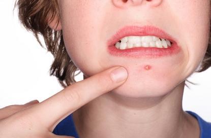 脸上爆痘 挤痘痘 用英文怎么说 这个真忍不了 知乎