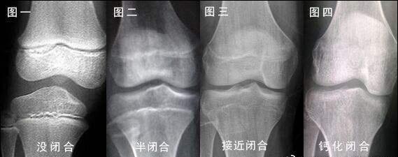 膝关节骨骺线图片