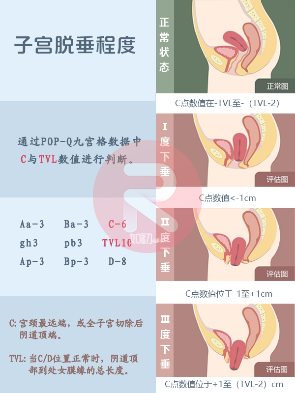 后壁膨出的清晰图片图片