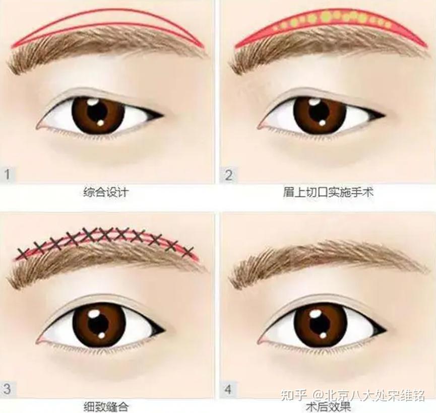 想做提眉\切眉手术,这7个问题你一定得清楚 - 知乎