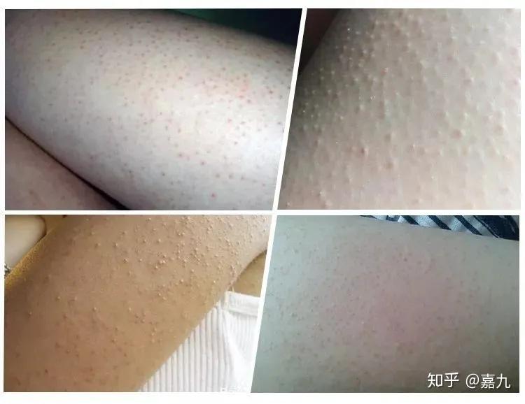 鸡皮肤在脸上吗(鸡皮肤会长在脸上吗)