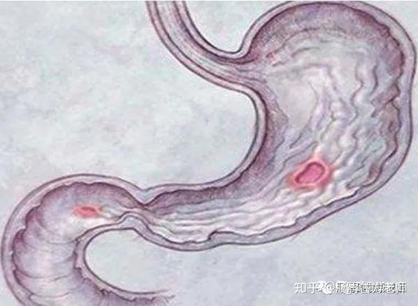 十二指肠溃疡2年中医一方治疗半年后溃疡痊愈