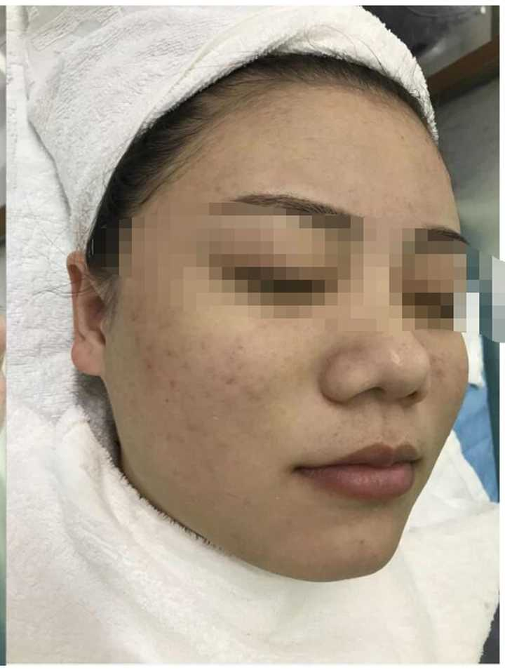 怎么能快速消痘痘 v2-140591cca70e85e4430a4bfafe2026f1_r.jpg