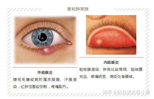 “麦粒肿”反复找上门，怎么办？ - 知乎