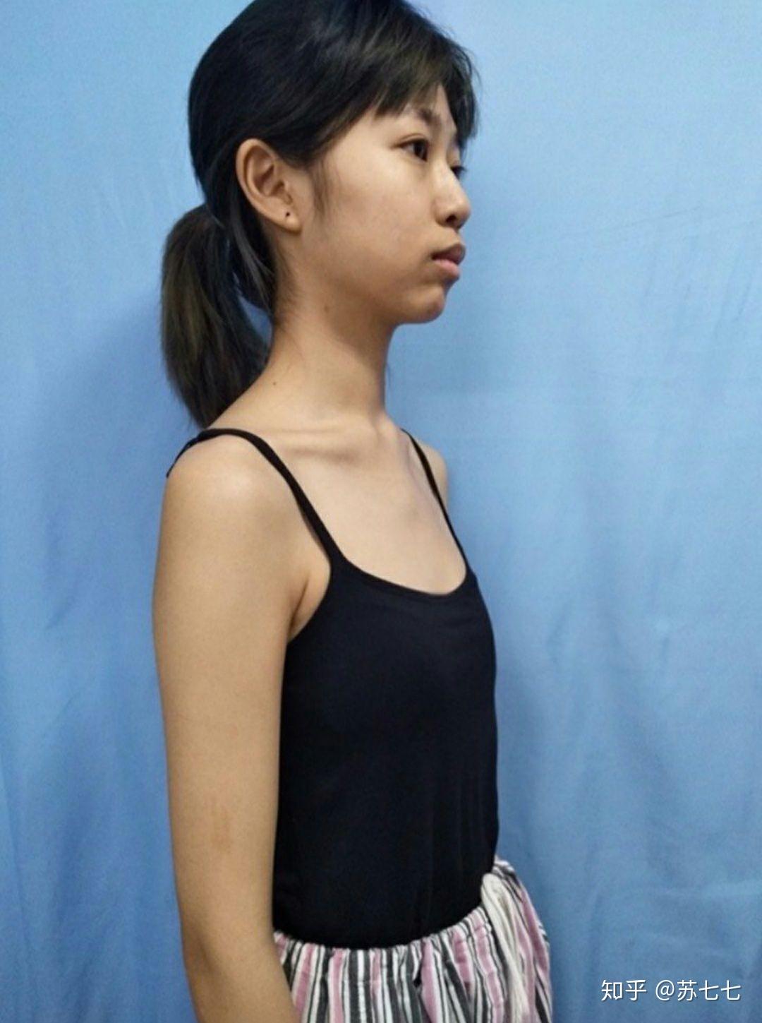 恐怖的隆胸手术!你还敢轻易去隆胸吗?