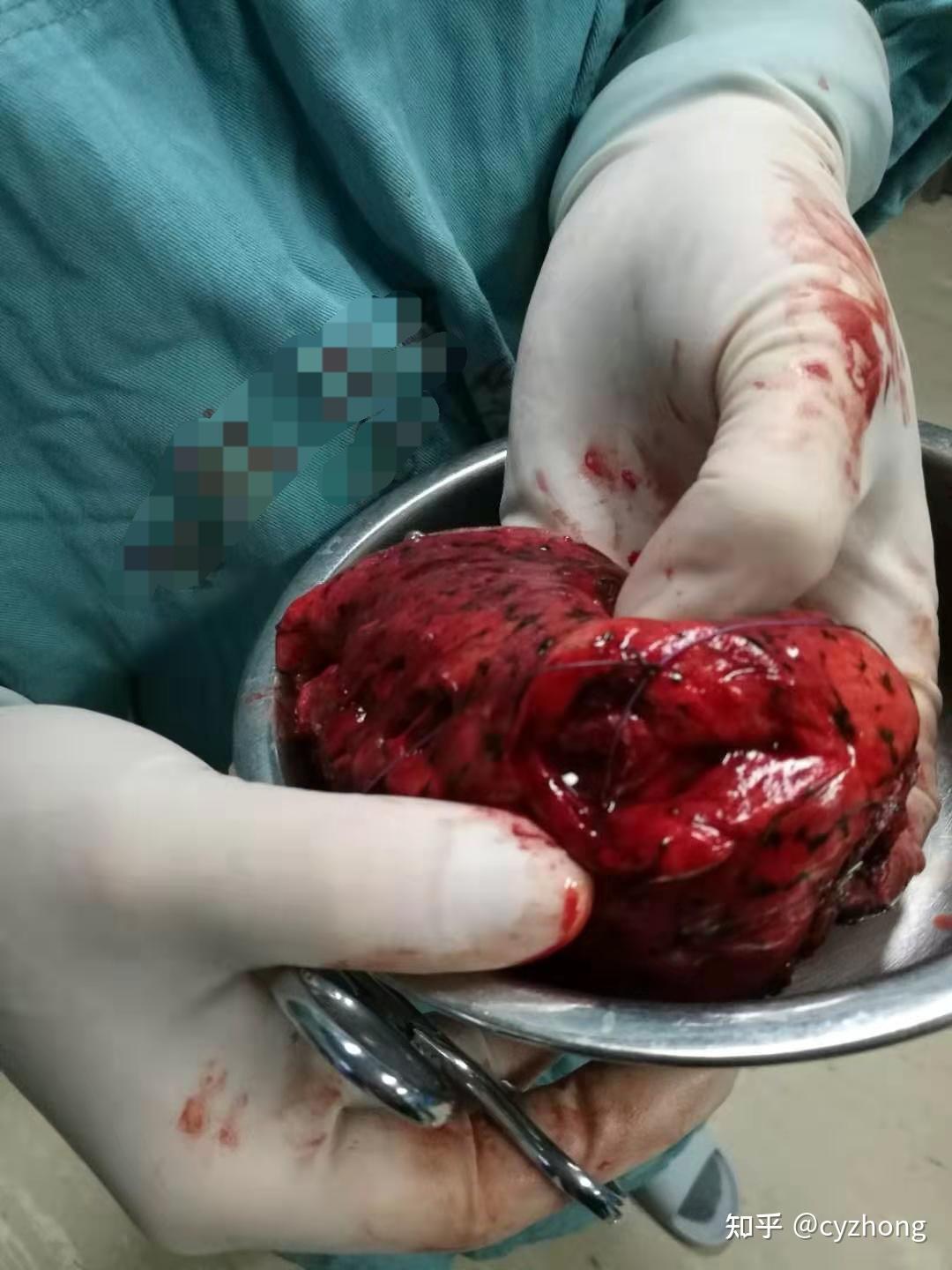 有没有肺结节开刀出来是良性的? - 知乎