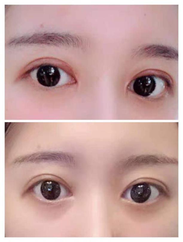 石家庄做双眼皮的医生风格,案例,反馈 - 知乎