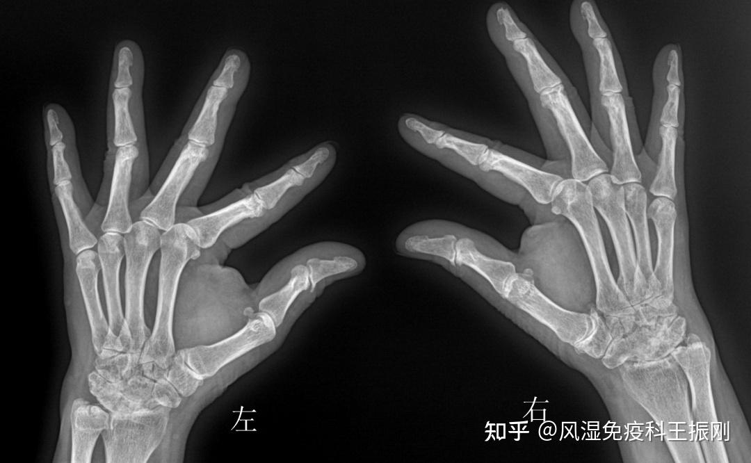 ra患者的手指关节畸形的x线片表现②ct检查ct对于ra可排除影像重叠