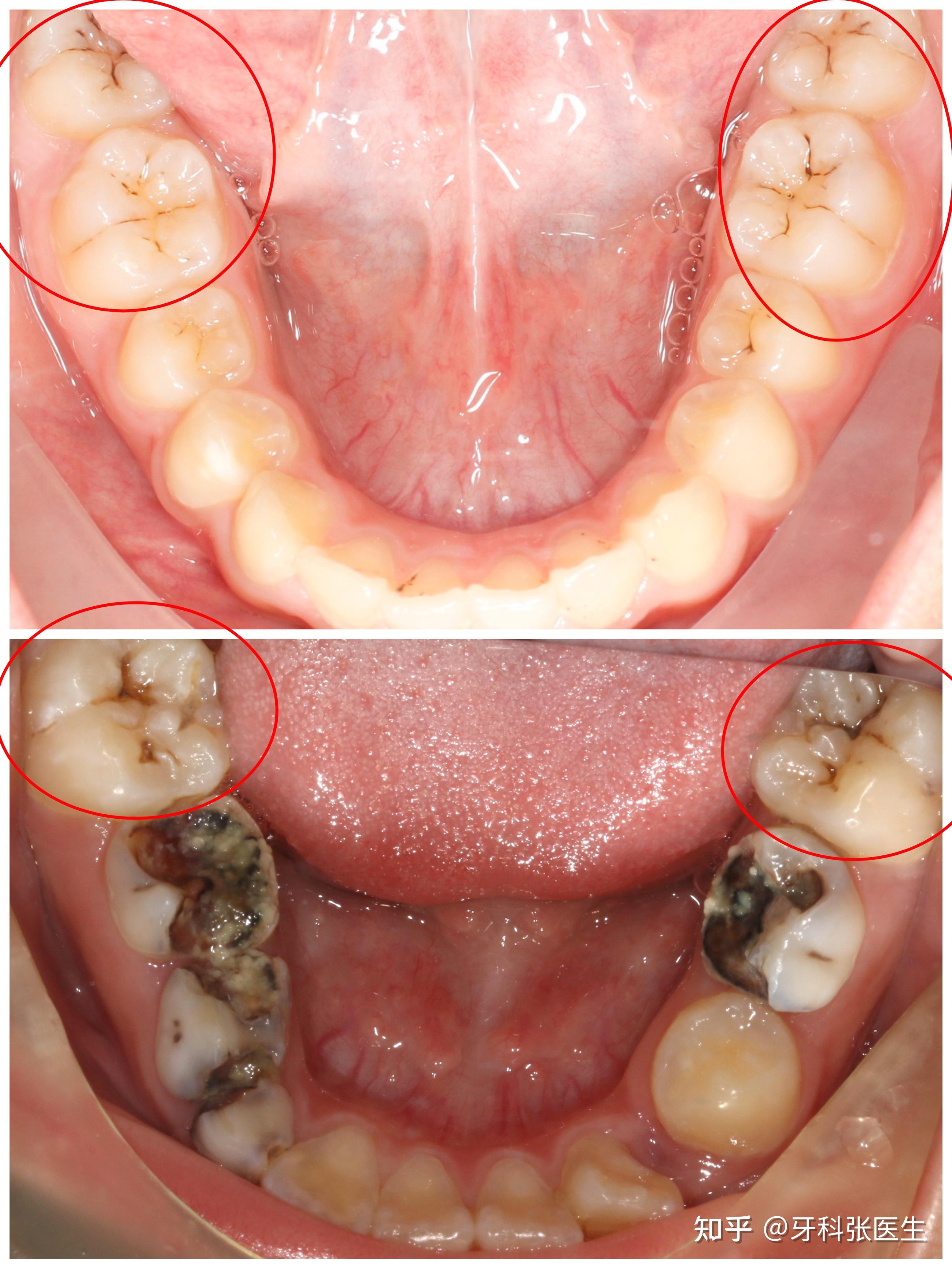 牙齿龋坏六中洞型图片图片