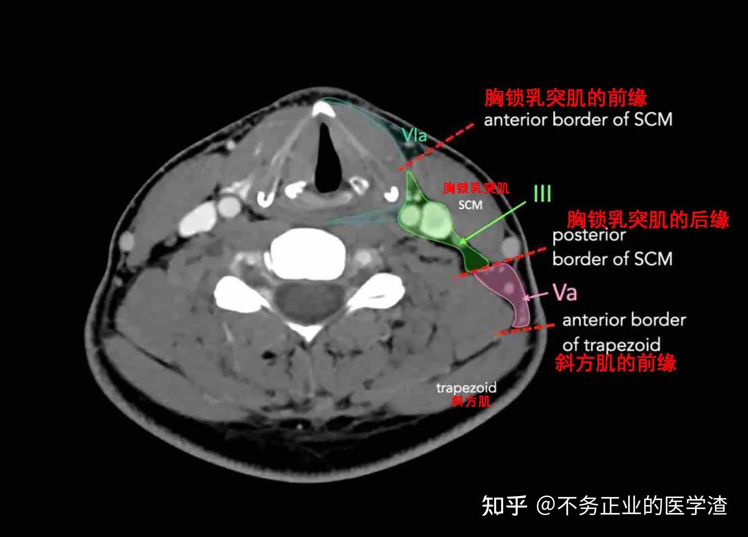 2013颈部淋巴结分区