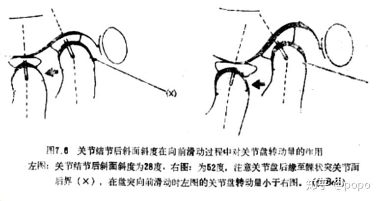 左图与右图的不同是,左图关节结节后斜面与眶耳平面的交角为28,右图