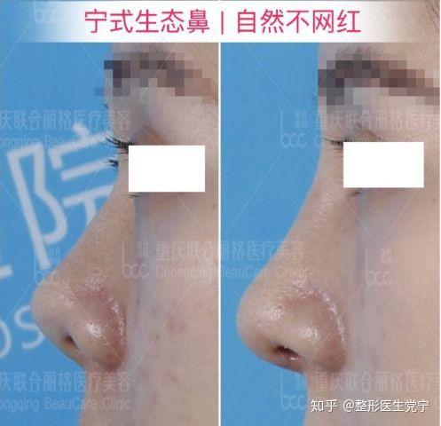 党宁隆鼻 l ″鼻″需要说(4) 朝天鼻怎么改善? - 知乎