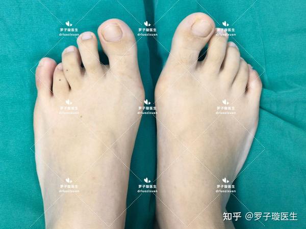 各种类型短趾症(脚趾短小症)术前术后对比。(持续更新中,20240513) - 知乎