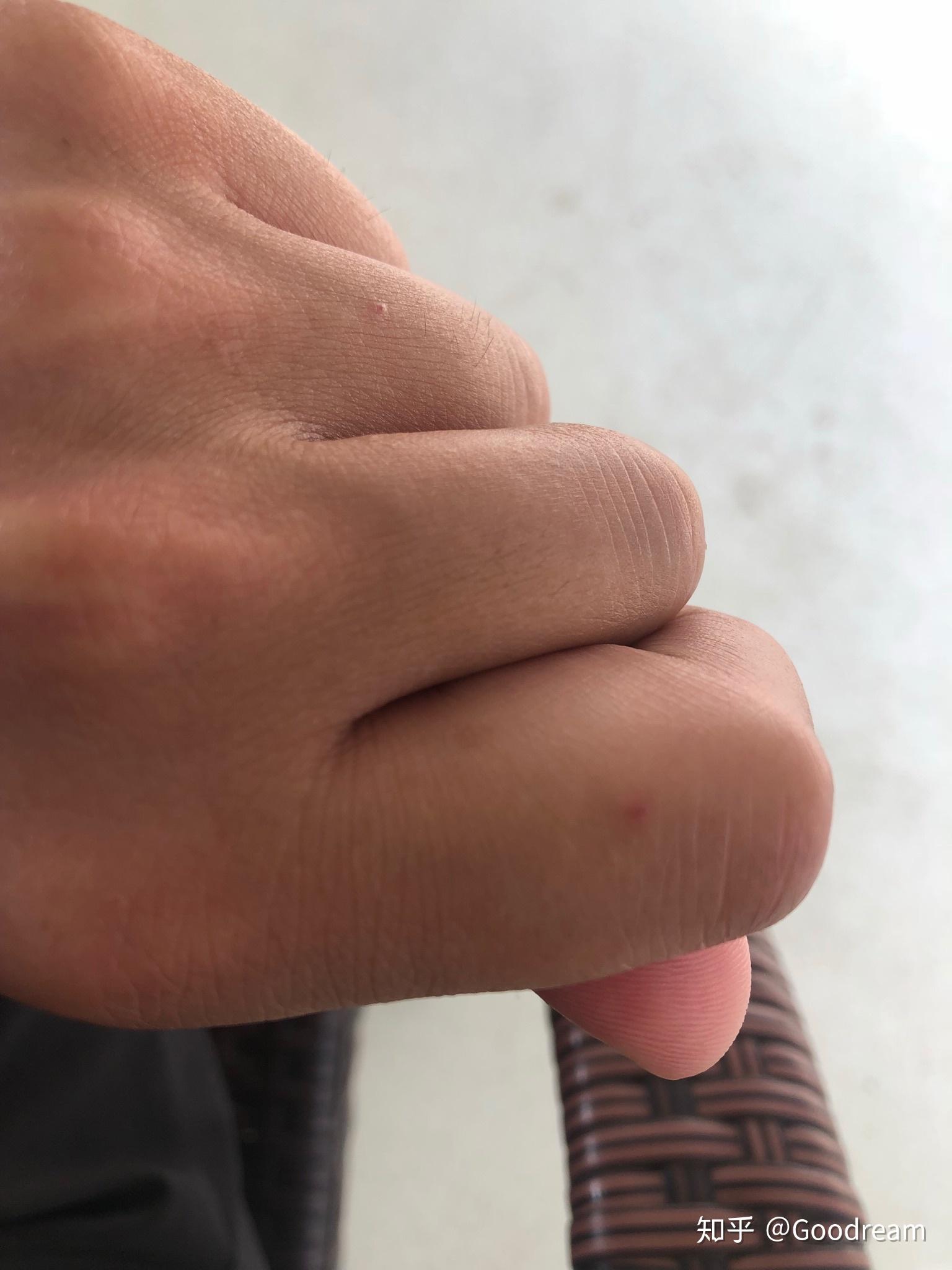 手上长的红痣是什么原因? - 知乎