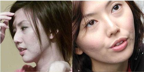 有鉴于最近很多朋友问我痘痘的事情终于鼓起勇气整理了一篇关于痘痘的