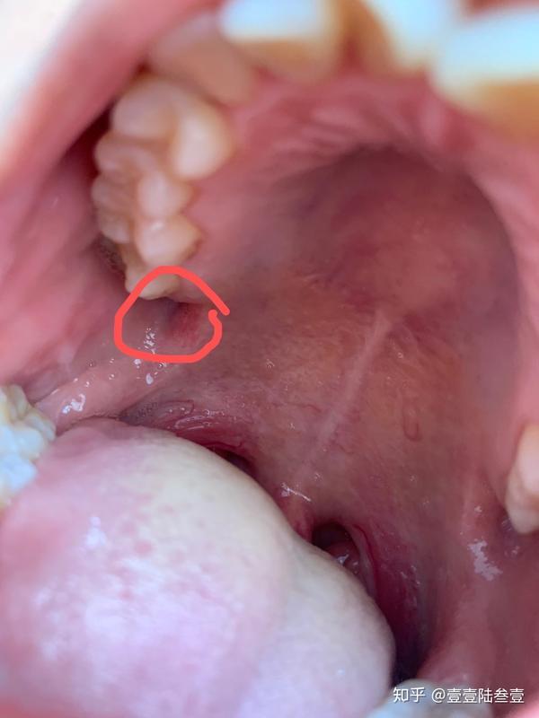 拔完智齿胶原蛋白线 拔智齿后胶原蛋白 Duboot网