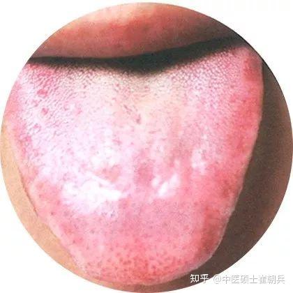 史上最全高清舌诊图谱,堪比教科书(收藏篇) - 知乎