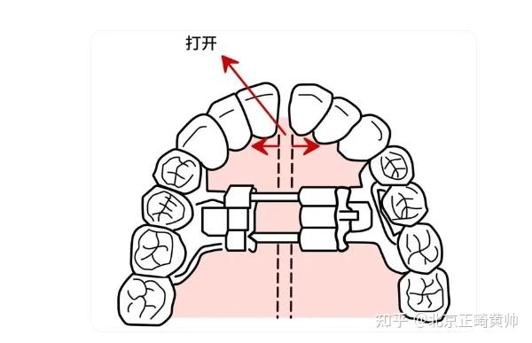 骨性扩弓 VS 牙性扩弓,到底扩的是哪里? - 知乎