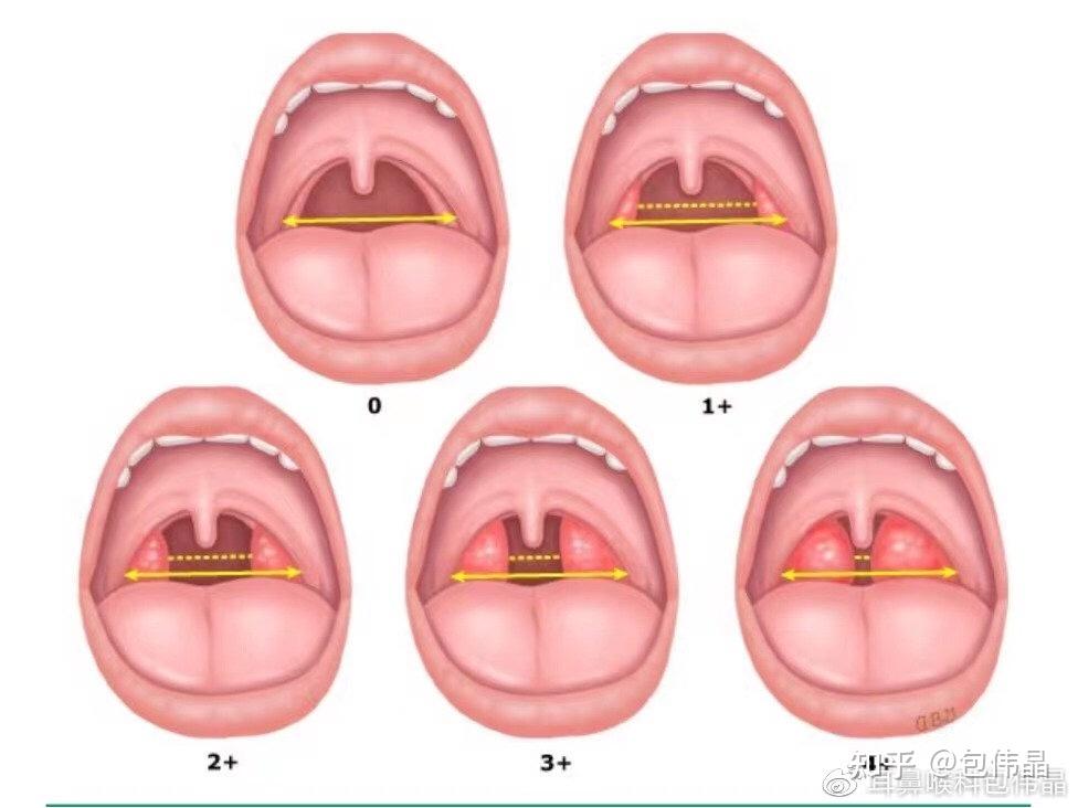 腭舌弓囊肿图片