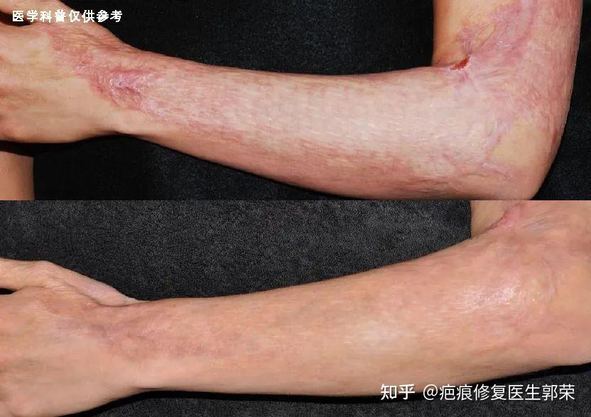 疤痕早期治疗的重要性千万别错过最佳治疗时期
