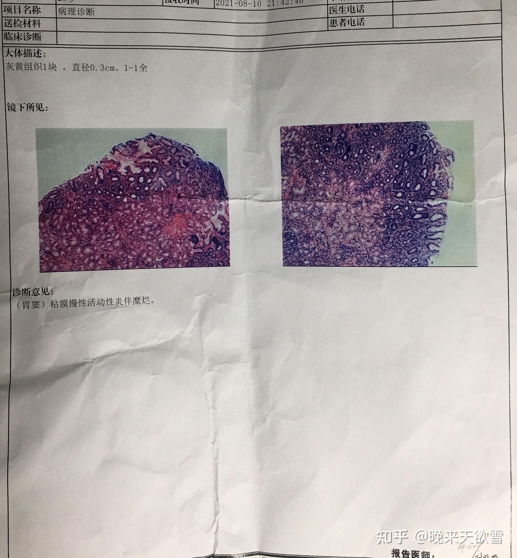 幽门螺旋杆菌病理图片图片