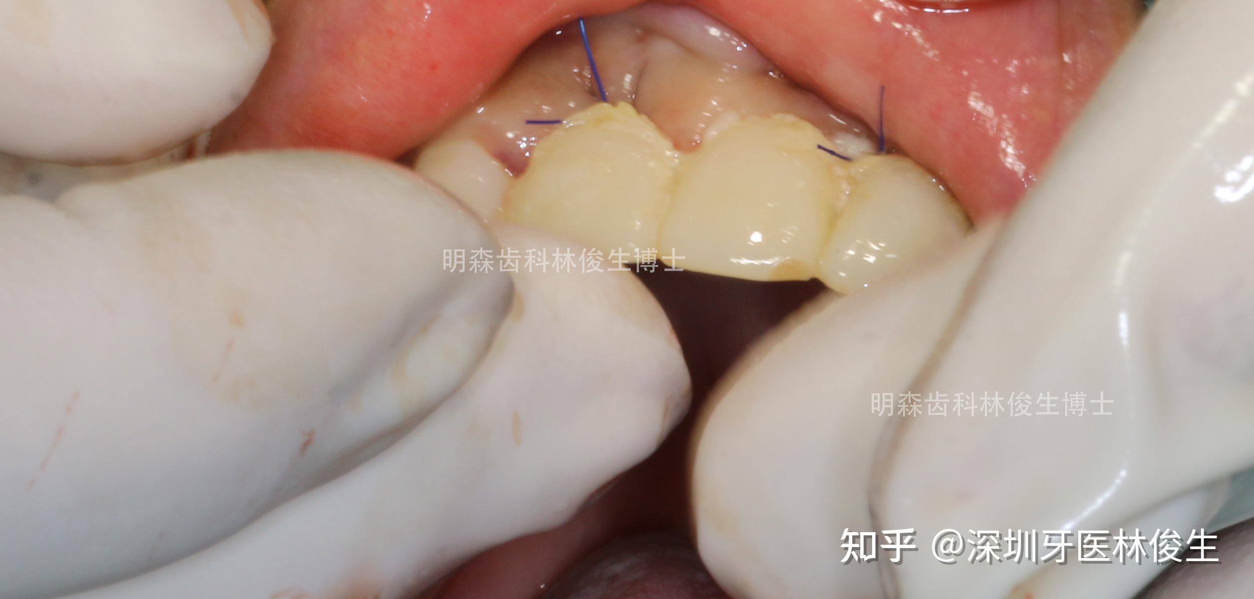 種植後他也非常關注口腔健康,期間出現過慢性根尖周炎和牙齦萎縮,他