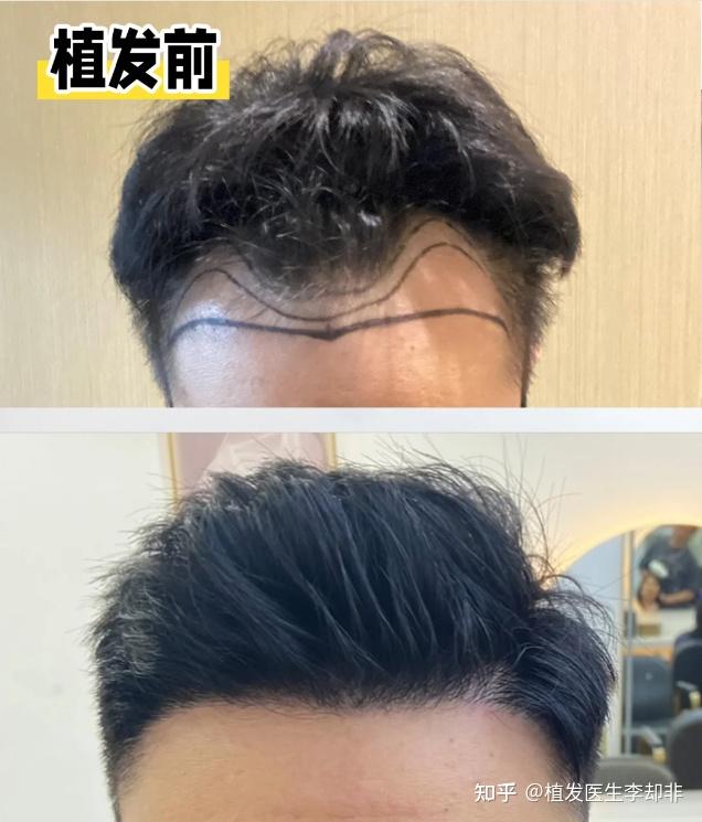 头大的人适合植发(头大的人弄什么发型好看)