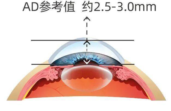 干货!高度近视想做PRL晶体植入术,“前房深度”很重要! 知乎