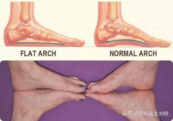 长期腰背痛 没想到原来是平足在作怪 知乎