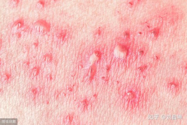 闻之色变的腰缠火龙近在眼前的带状疱疹正确看待才能