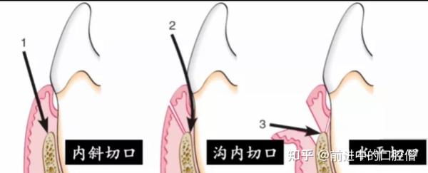 冠延长术的图解图片