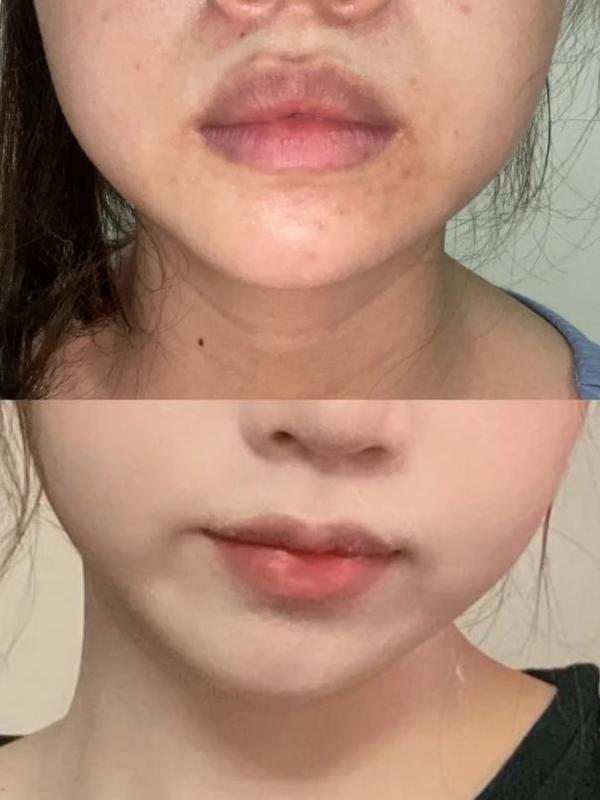 厚唇改薄有好的医院吗?做m唇价格多少?有无案例?