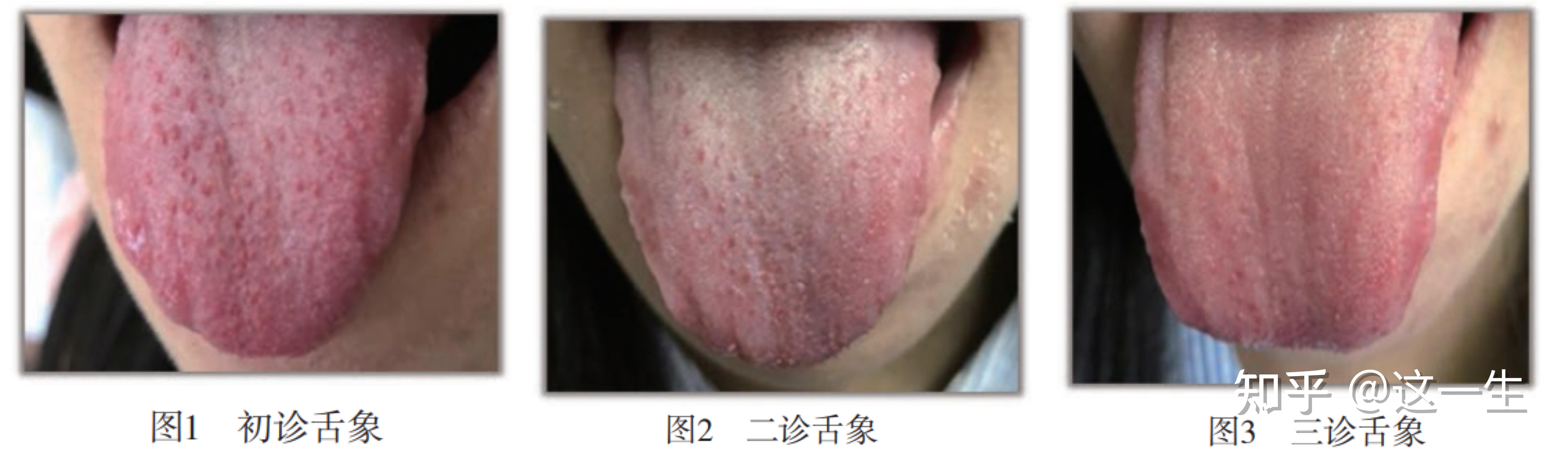 草莓舌不是食积化热,聊聊芒刺舌 - 知乎