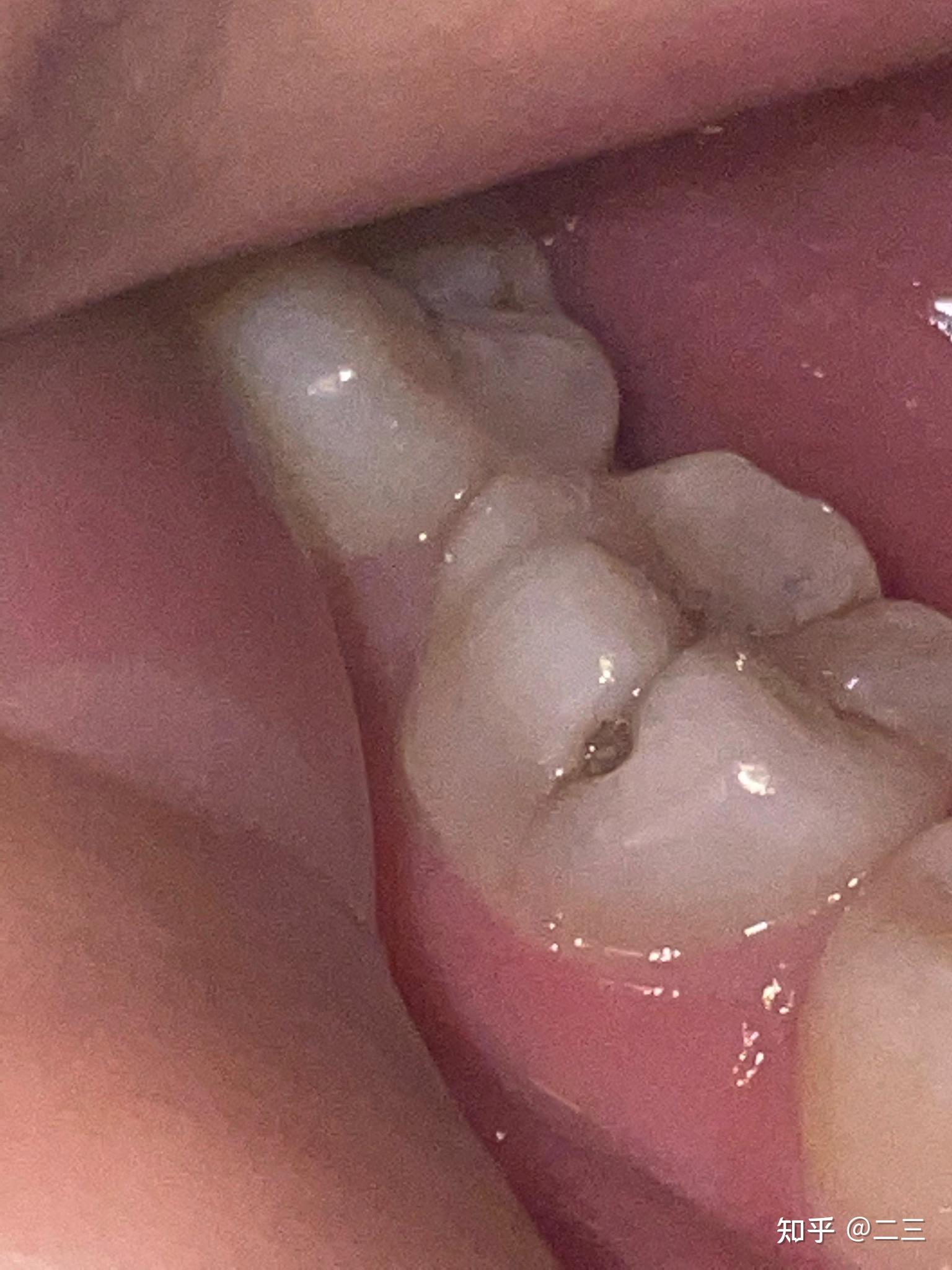 牙齿侧面有个洞图片
