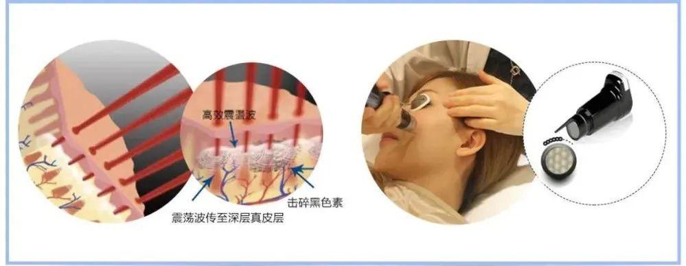 皮秒激光大百科,常见皮秒仪器如何选择? - 知乎