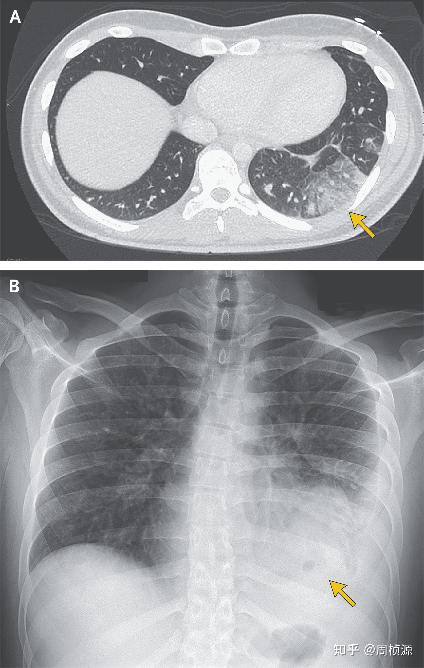 Nejm 2023 Case 9 知乎