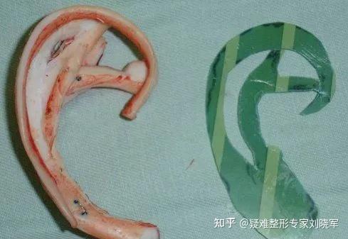 耳畸形修复再造的耳朵和真耳朵有什么区别