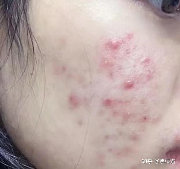 油皮敏肌如何应对突发爆痘？皮肤严重缺水后用哪款急救面膜更合适？ - 知乎