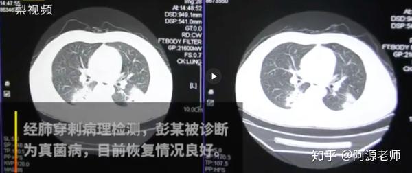 惊奇 闻袜子得了肺炎 是吸入性肺炎么 最可能是哪种真菌 知乎