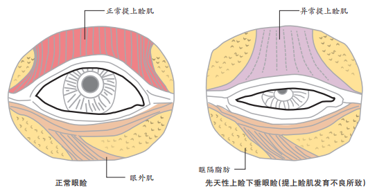 有的則是後天形成的,單側性的,外傷,屬於病後肌肉或動眼神經損傷的