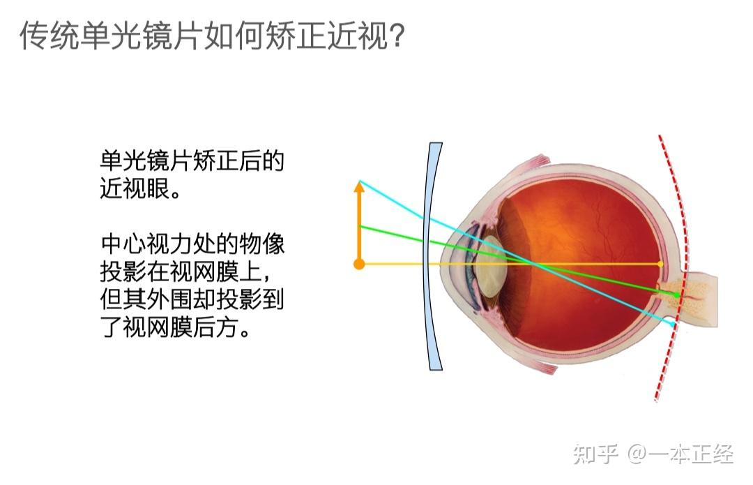 青少年戴漸進好還是單光好