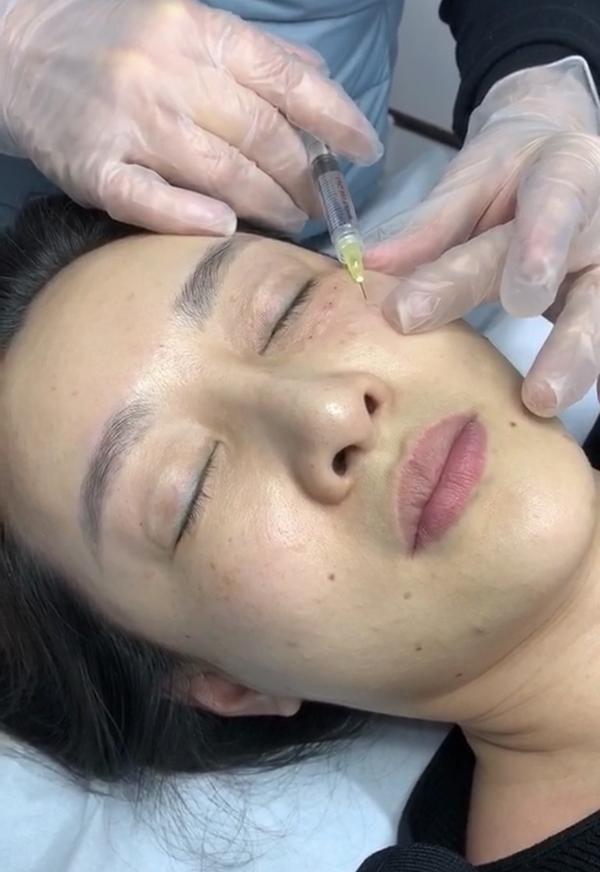 利用负压的多头针水光枪或手打方式在皮肤的真皮层注入透明质酸等产品