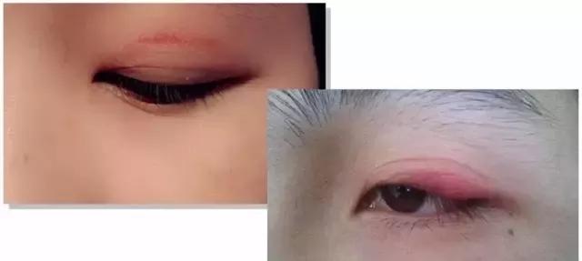 365天贴双眼皮贴结果危害这么大劝你真的别贴了