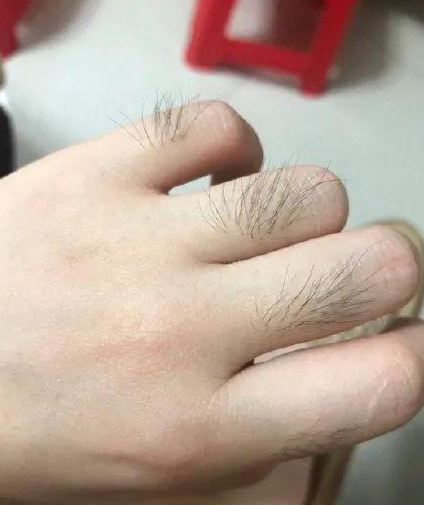 手臂和腿上的毛,这就算了,我之前手指上长毛,我给刮了然后……然后