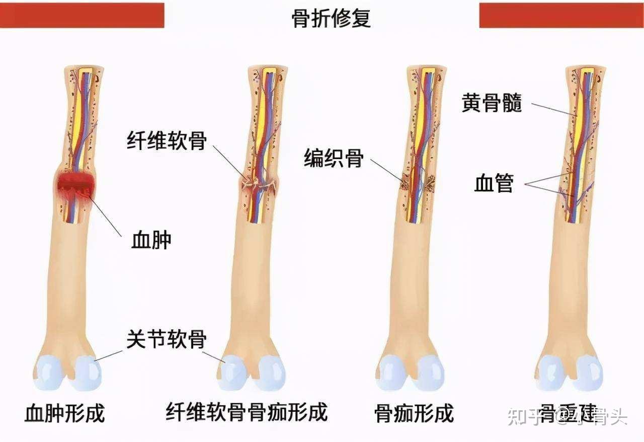 刺激骨痂生长的办法图片