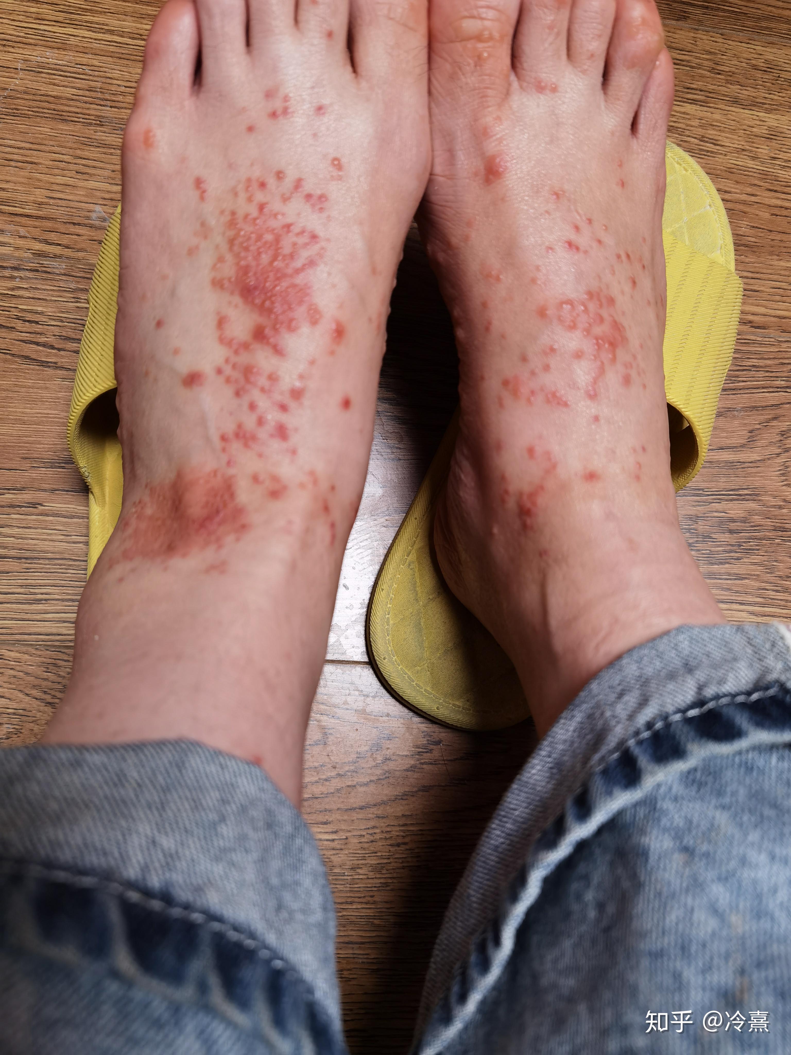 脚过敏性皮炎症状图片图片