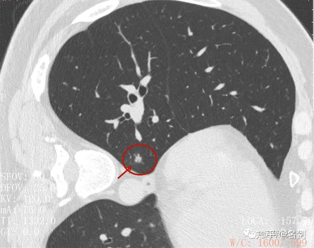细致剖析肺结节到底是不是癌?郑州30岁小伙来金华面诊