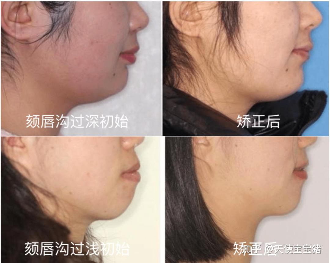 聊聊早矫之凸嘴